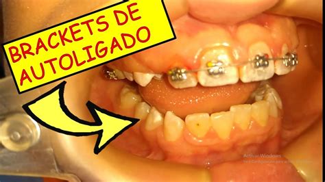 bracket autoligado metalico|cómo funcionan los brackets.